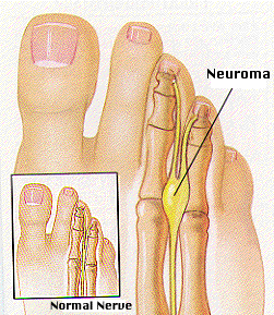 neuroma-de-morton