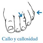 callo-callosidad