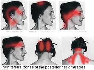 Dolor cervical, de cuello, y tratamiento en Tarragona - Dolortarragona