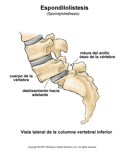 espondilolistesis