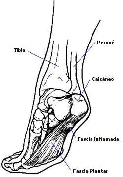 fascia-plantar-2