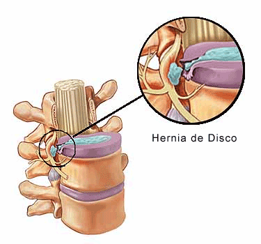 hernia-de-disco