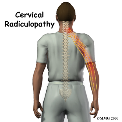 radiculopatia_cervical